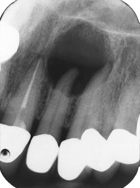 apisectomy