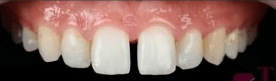 Teeth gap 1