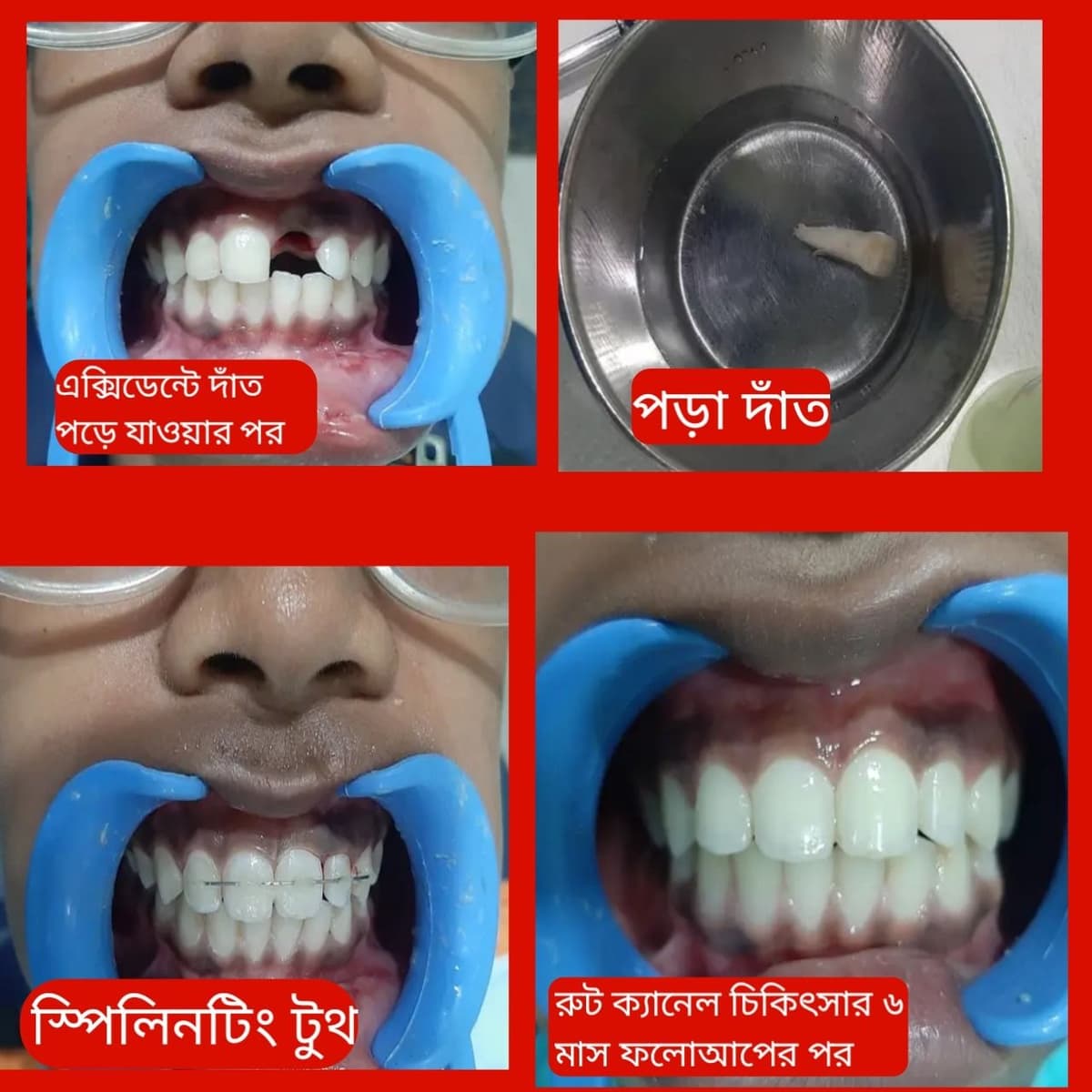 Avulsed tooth
