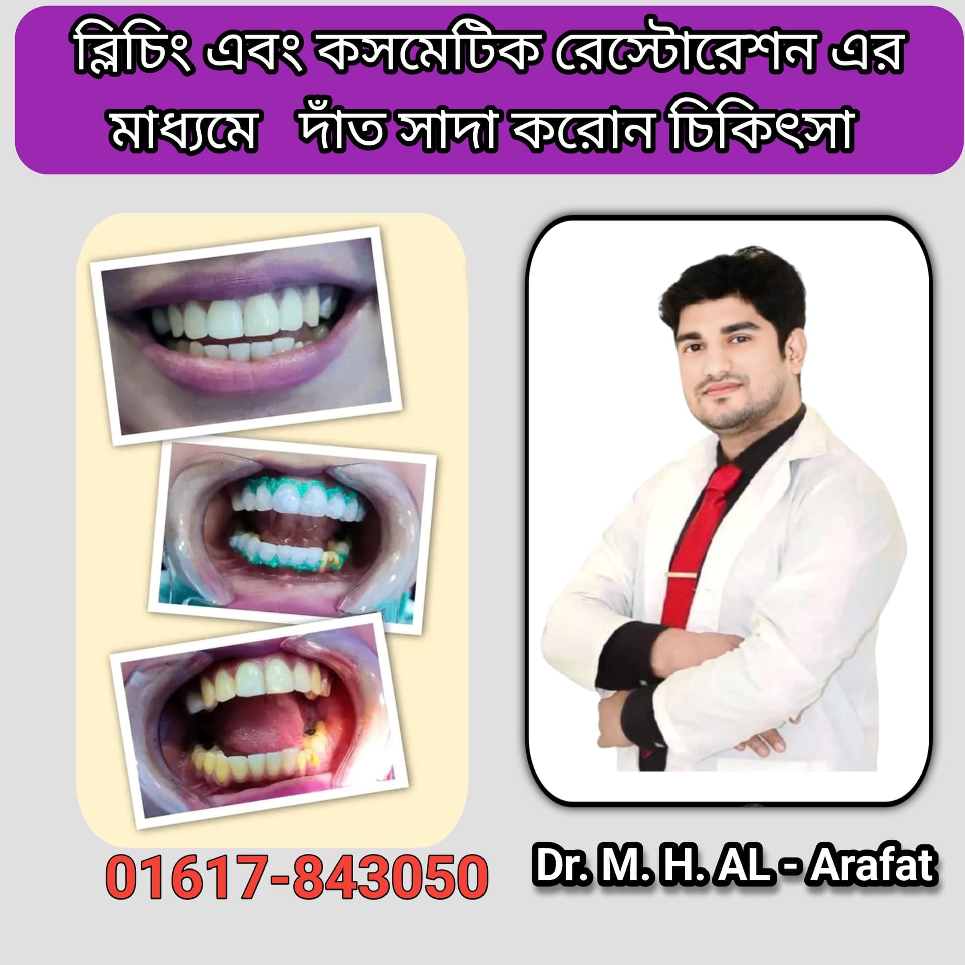 tooth whitening 