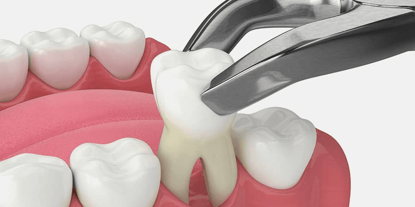 Teeth removval