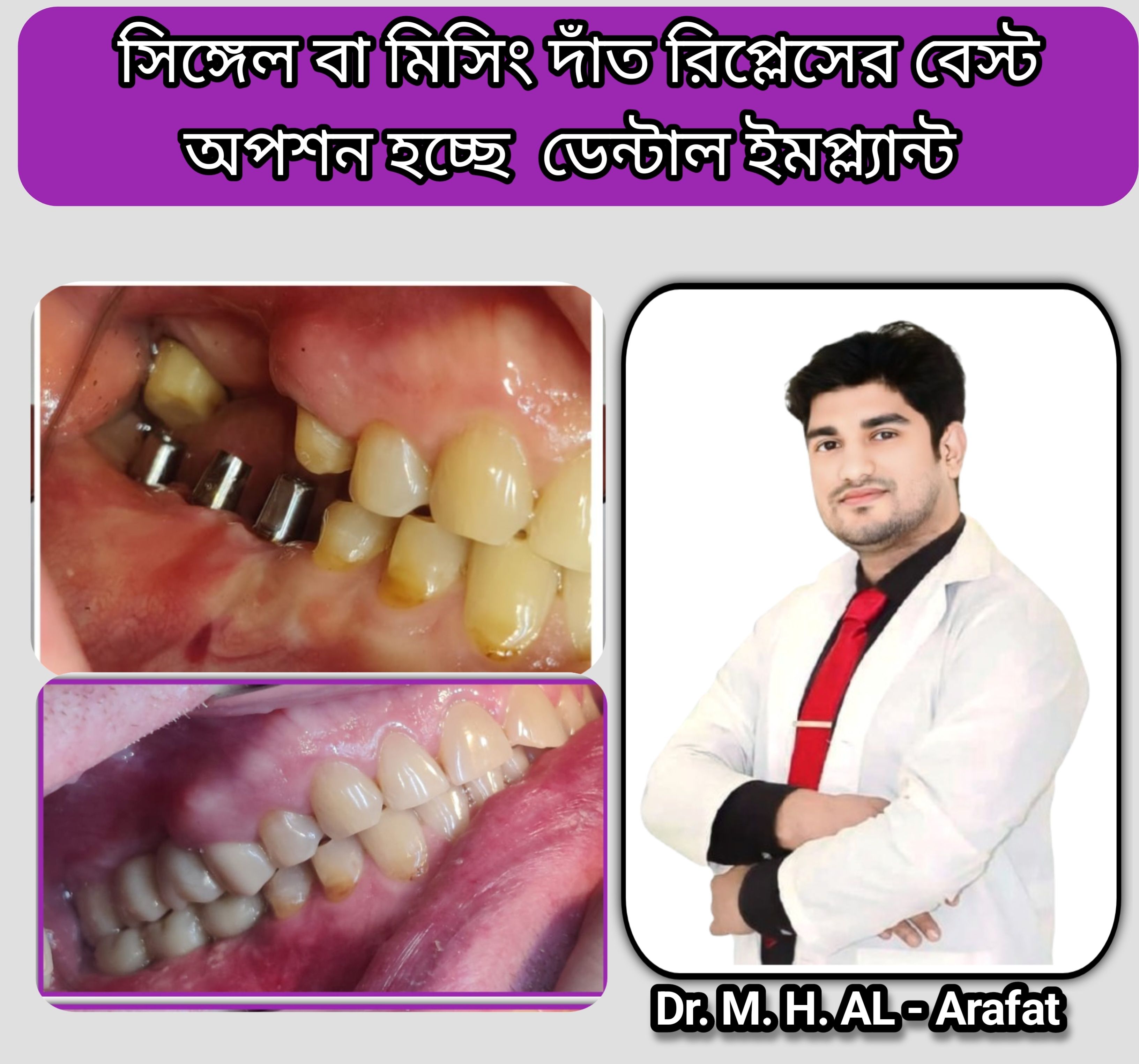 implant