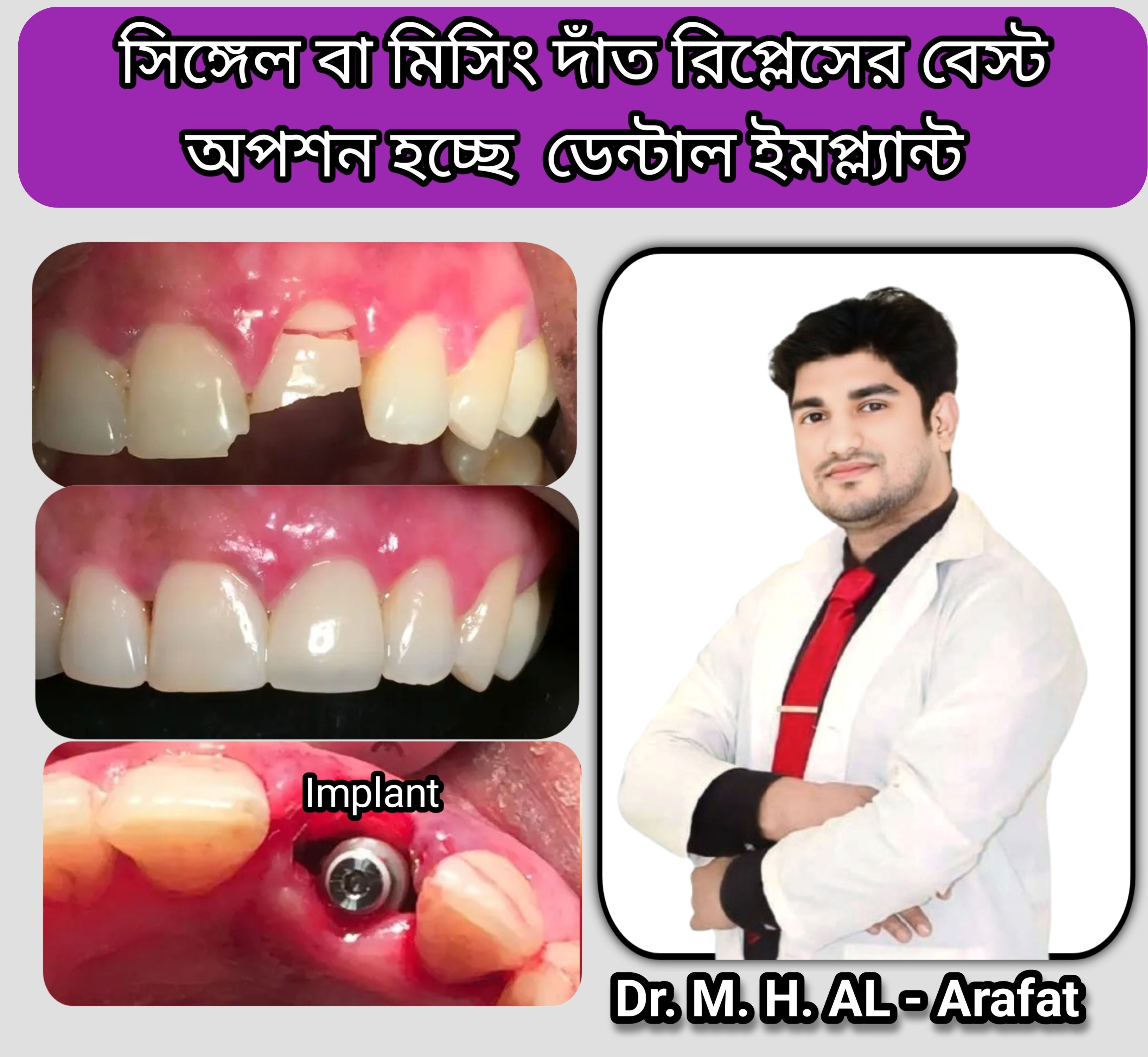 implant