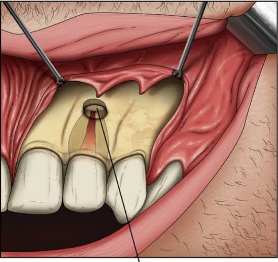 apisectomy