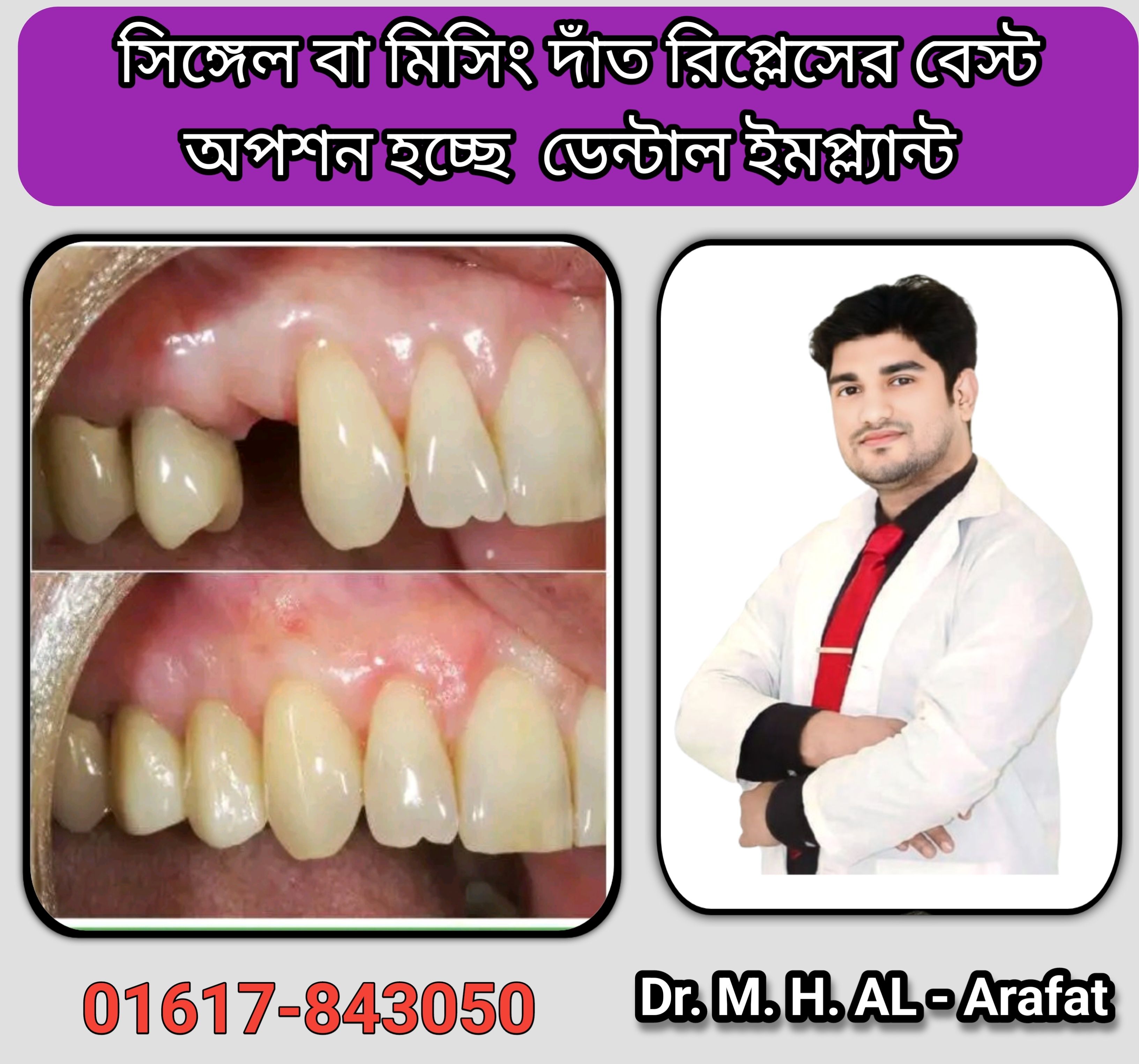 implant