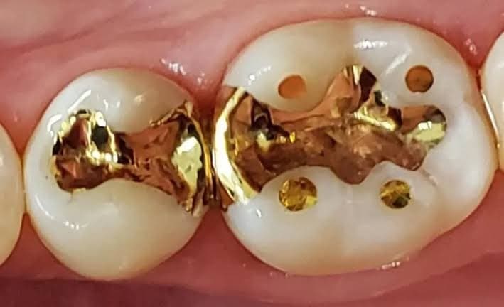 gold filling