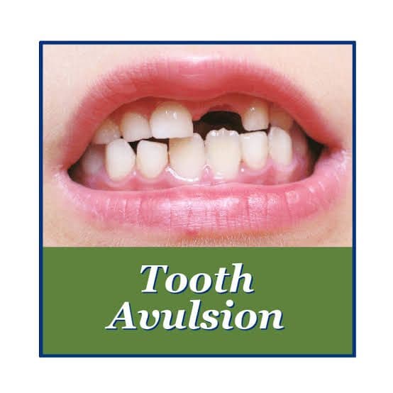 Avulsed tooth