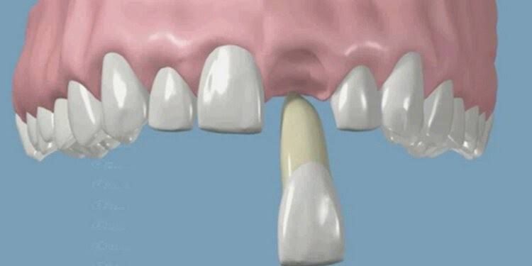 Avulsed tooth