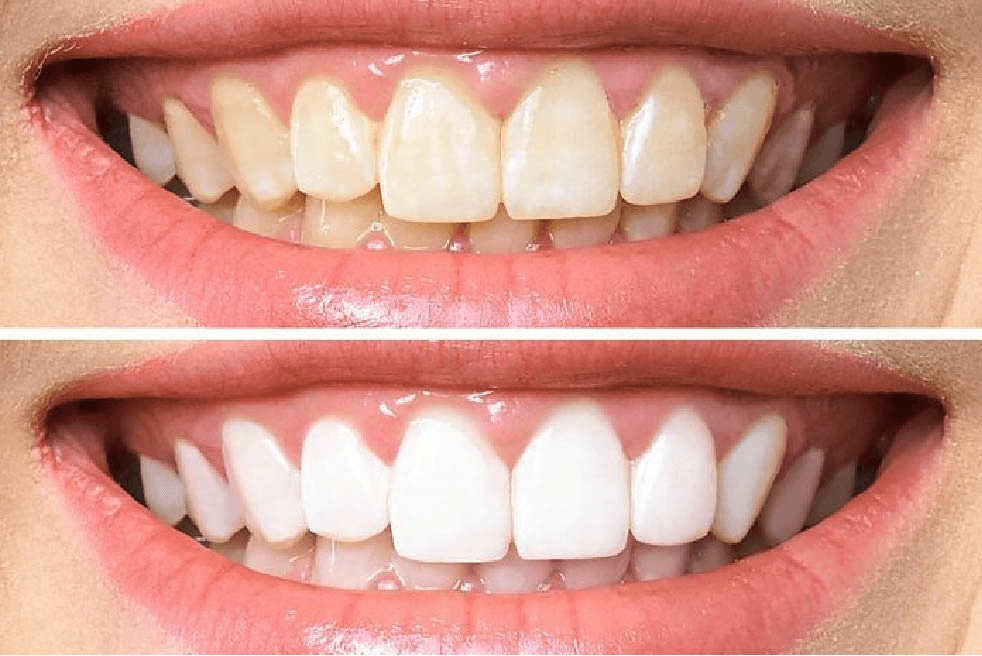 tooth whitening
