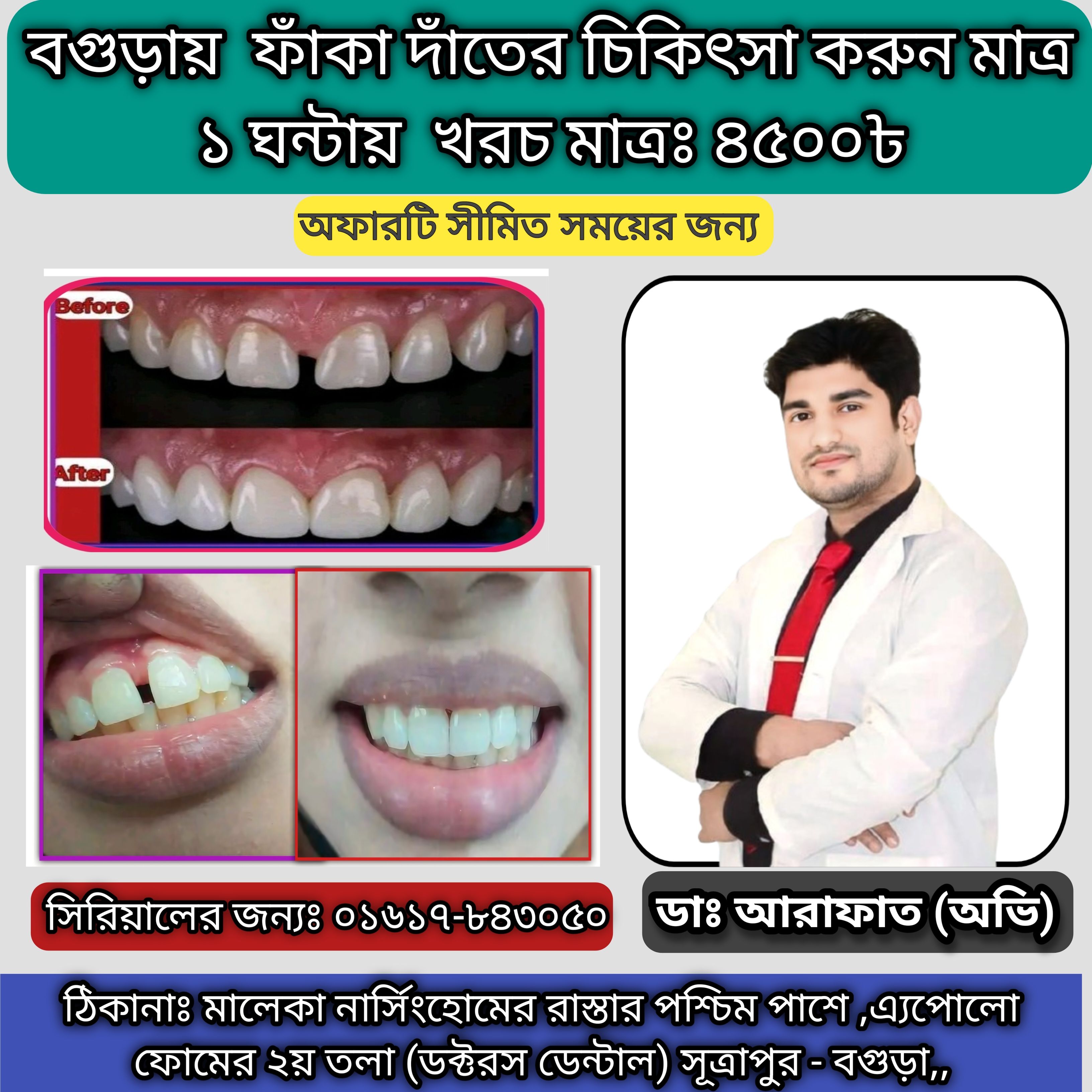 tooth gap