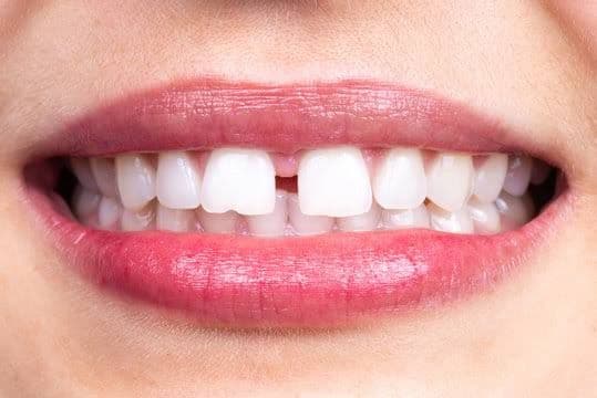 tooth gap