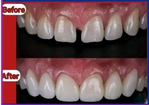 Composite veneers