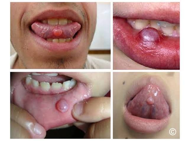 mucocele